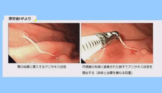 アニサキスの食中毒が倉吉市で発生　イワシの刺身を食べ５時間後に激しい胃の痛みと吐き気（鳥取・倉吉市）