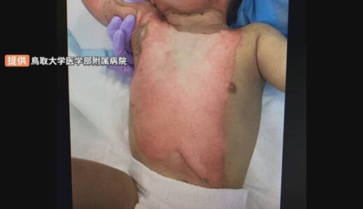 全身の皮膚の40％に重いやけど　２歳未満男児の救命に成功　自家培養表皮・人工真皮を使った治療で国内初　鳥取大学医学部附属病院