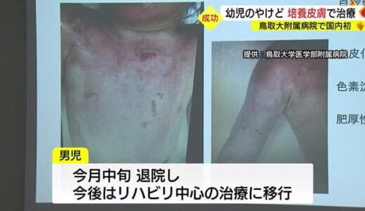 国内初の成功例を発表　全身約４割やけど２歳未満の子どもに特殊な皮膚移植の治療（鳥取県・鳥大付属病院）