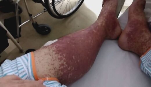 人気の牛骨白湯ラーメン店が突然臨時休業　足が腫れあがり、全身に激痛…店主を襲った「IgA血管炎」とは？