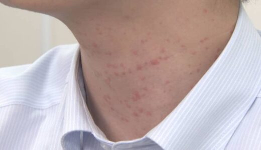 全身に赤いブツブツ…年度がわりは「じんましん」に注意　環境変化、ストレスがきっかけで発症するケースも