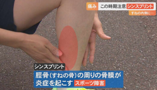 「すねの内側が痛い」運動部の新入生、この時期多い…スポーツ障害「シンスプリント」とは？