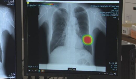 肺がん検診など胸部Ｘ線診断に「ＡＩ」導入　検診分野では中四国初