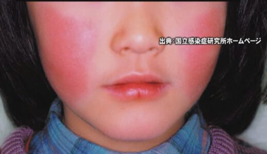 「りんご病」流行、警戒　特に妊婦は注意必要「流産の原因になったりもする」医師指摘